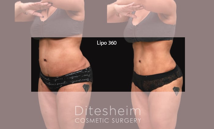 A before and after side-view comparison of a patient who underwent Lipo 360, showing enhanced abdominal definition and a more contoured waistline.