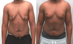 Gynecomastia treatment 15 year old boy