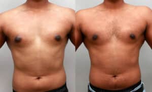 19 year old teen gynecomastia treatment