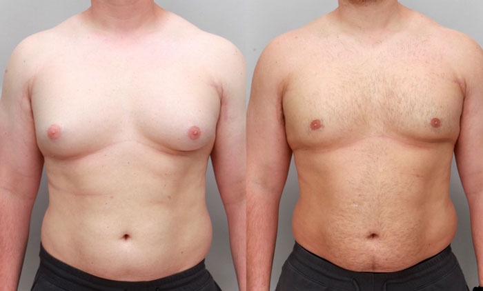 Grade 2 before and after gynecomastia treatment