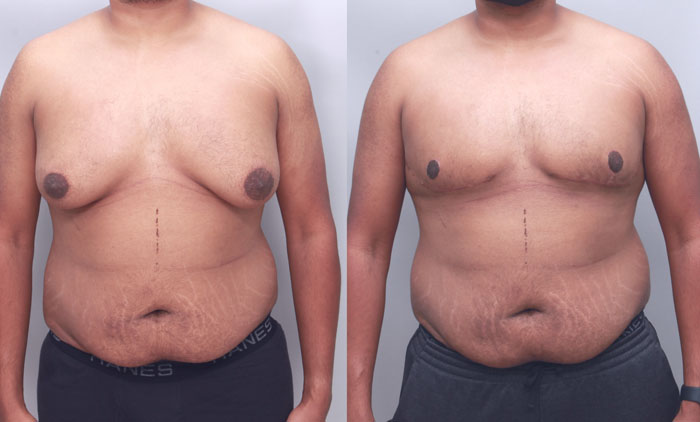 Grade 3 gynecomastia after weight loss