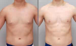 Teen gynecomastia surgery Charlotte NC