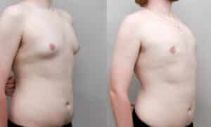 Teen Gynecomastia surgery after 70 lb weight loss
