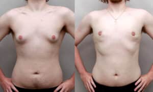 Gynecomastia surgery after teen weight loss