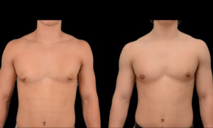 Puffy nipples gynecomastia treatment
