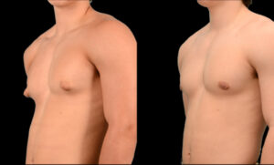 Teen gynecomastia treatment for puffy nipples