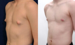 Male breast reduction 14 year old teen