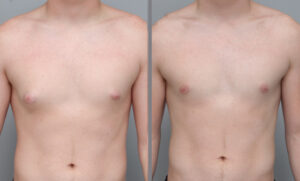 Teen gynecomastia surgery and treatment from prohormones.
