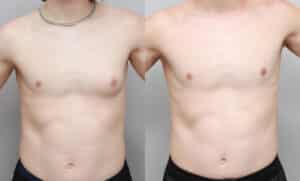 13 year old unilateral gynecomastia treatment
