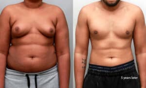 Teen gynecomastia surgery 15 year old boy