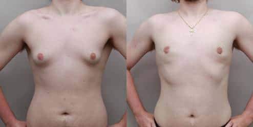 Teen Gynecomastia Surgery in Charlotte, NC