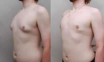 Gynecomastia Surgery for Teens in Charlotte, NC.