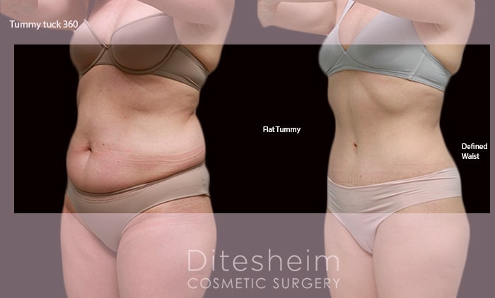 Tummy Tuck, Liposcution 360, Charlotte, NC, Ditesheim Cosmetic Surgery