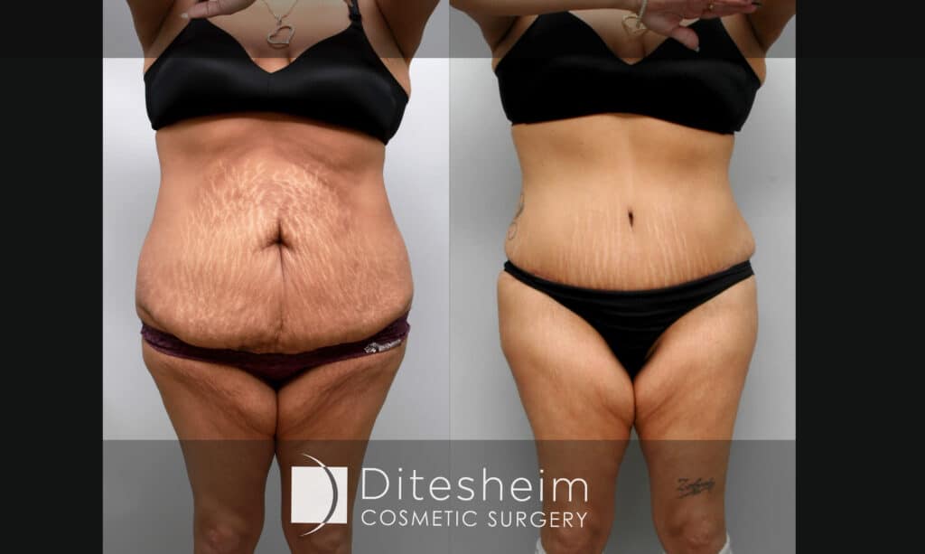 Lost waist definition tummy tuck surgery