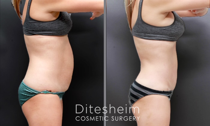 Tummy Tuck Body Contouring in Charlotte