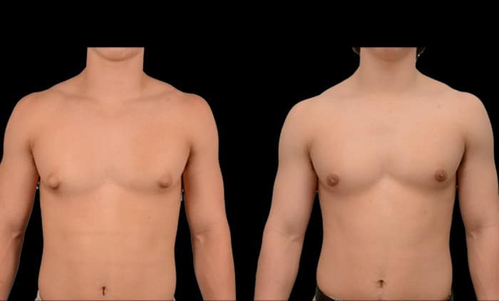 Gynecomastia surgery correcting enlarged male breast tissue