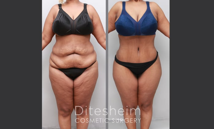 Apron or Hanging tummy tuck