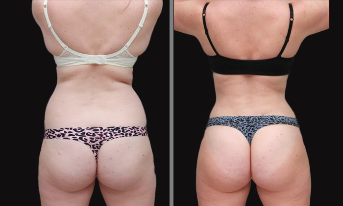 Mommy makeover rear view