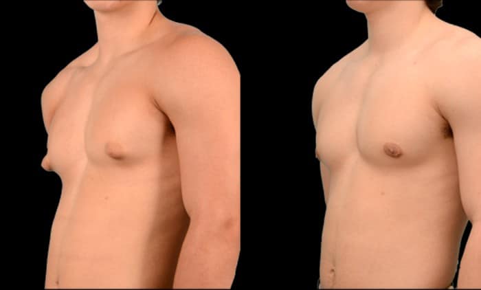 Teen gynecomastia showing enlarged breast tissue in an adolescent male chest