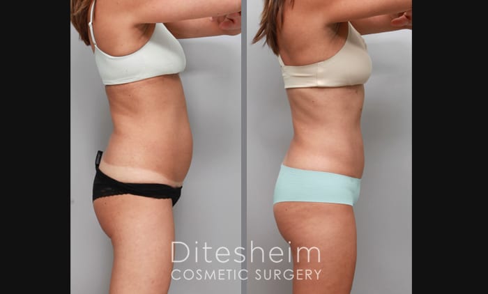 Tummy tuck with a rounded bulge and strong core.