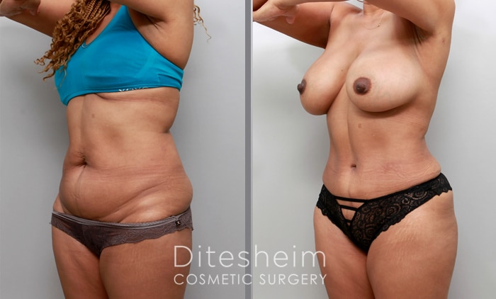 Tummy tuck and breast augmentation woman of color2