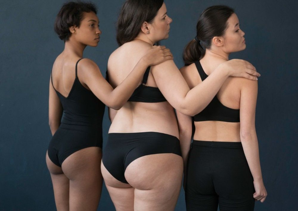 Women standing together before undergoing specialized lipedema reduction surgery treatment