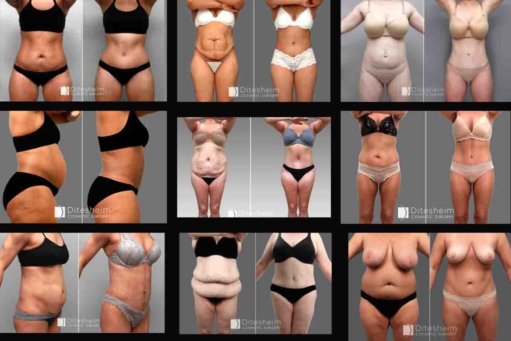 Tummy tuck patients in Charlotte NC - Dr Ditesheim