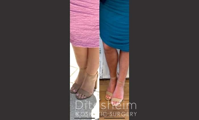 Lipedema affecting the lower body with enlarged legs and preserved feet appearance