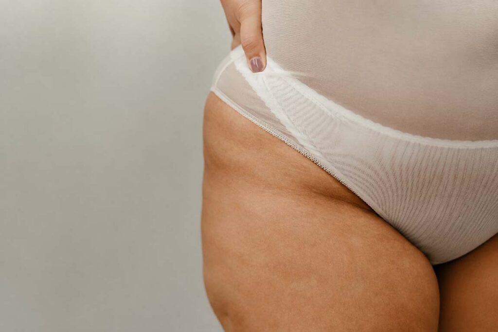 Woman’s thigh and hip showing lipedema-related skin texture before treatment at Ditesheim Cosmetic Surgery, Charlotte, NC