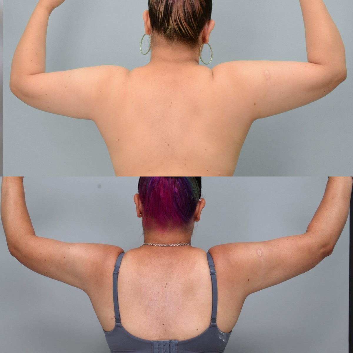 Arm liposuction before and after, 40-year-old woman, rear view with arms raised, 6 months after surgery, Ditesheim Cosmetic Surgery Charlotte NC