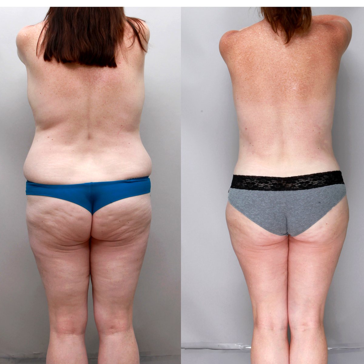 Back, waist and buttock liposuction before and after, 50-year-old woman, rear view, 6 months after surgery, Ditesheim Cosmetic Surgery Charlotte NC