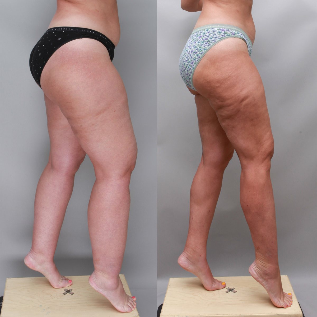 Leg, calf and ankle liposuction before and after, 44-year-old woman with lipedema, side view, 6 months after surgery, Ditesheim Cosmetic Surgery Charlotte NC