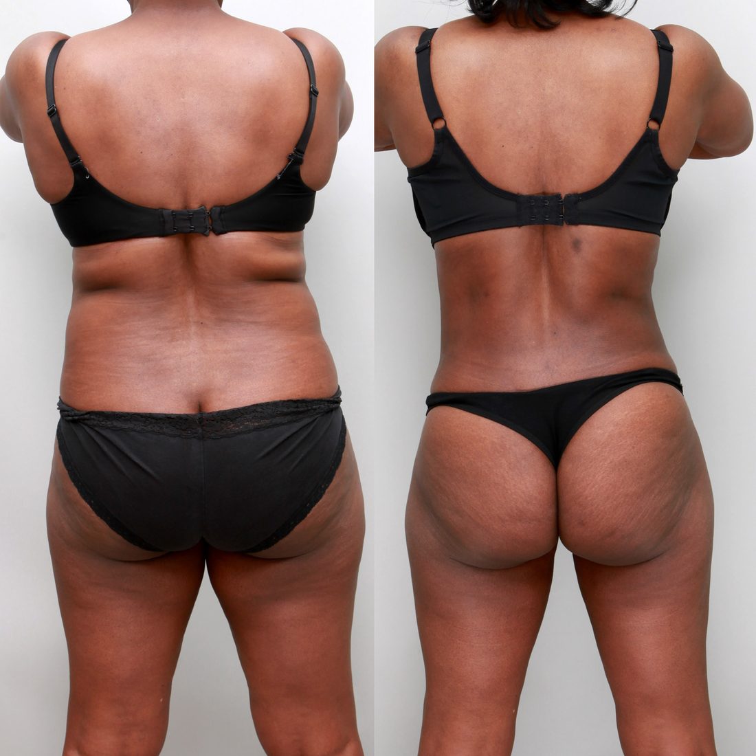 Lipo 360 before and after, 51-year-old woman, rear view, 1 year after surgery, Ditesheim Cosmetic Surgery Charlotte NC
