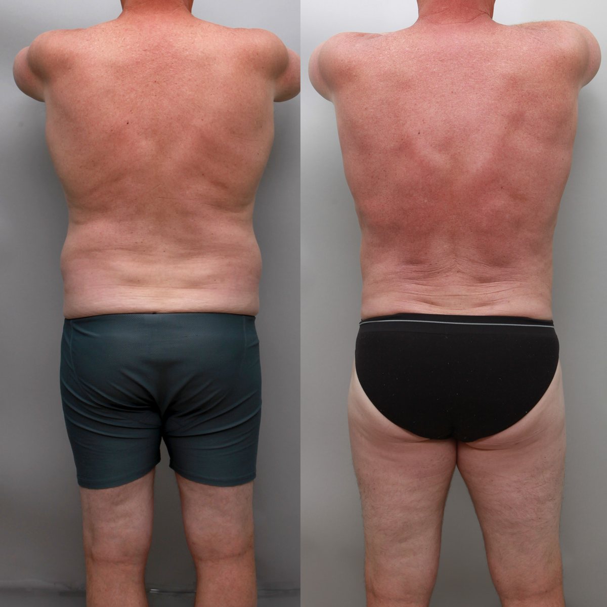 Love handles and lower back liposuction before and after, 59-year-old man, rear view, 4 months after surgery, Ditesheim Cosmetic Surgery Charlotte NC