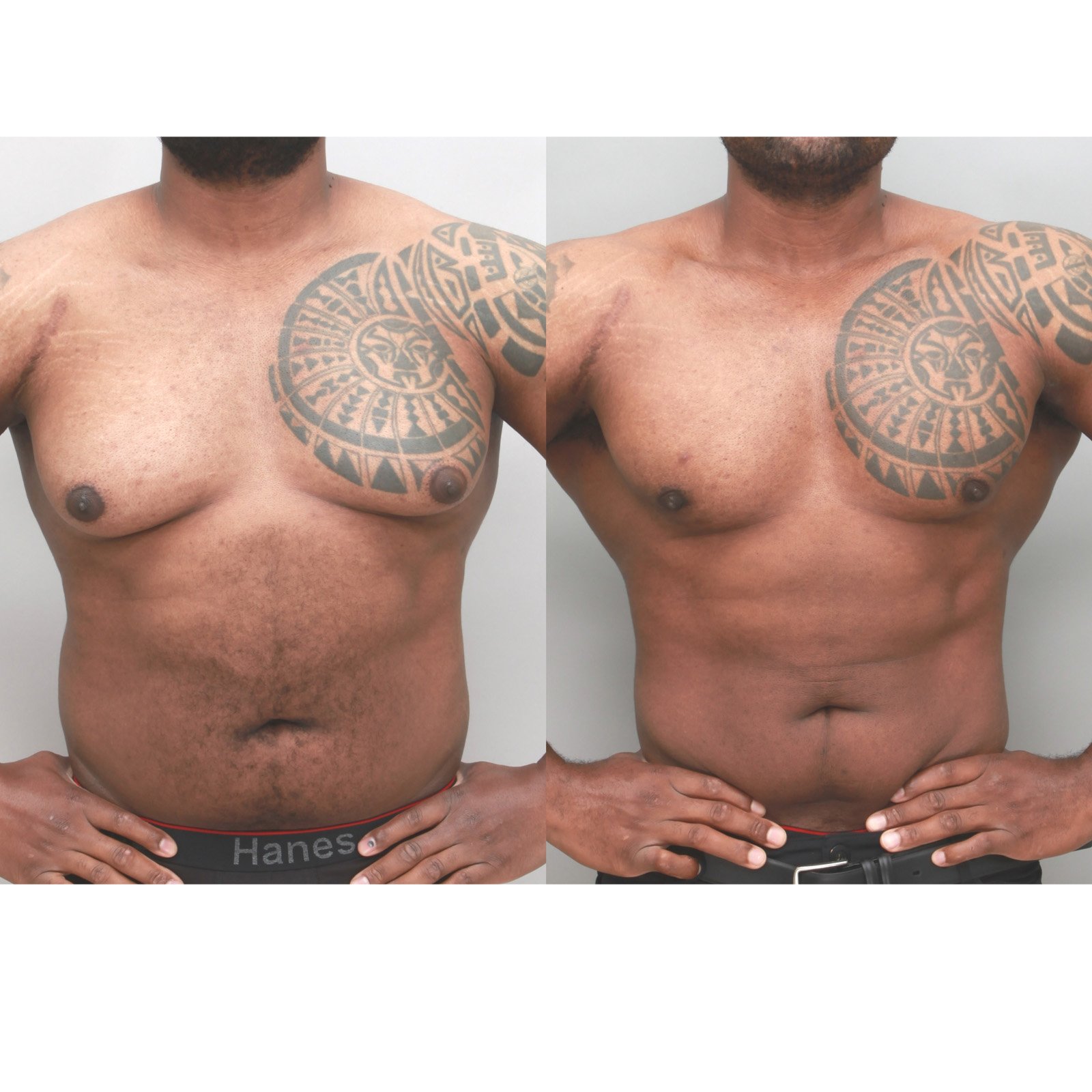Male chest gynecomastia before and after, 32-year-old man, front view, 3 months after surgery, Ditesheim Cosmetic Surgery Charlotte NC