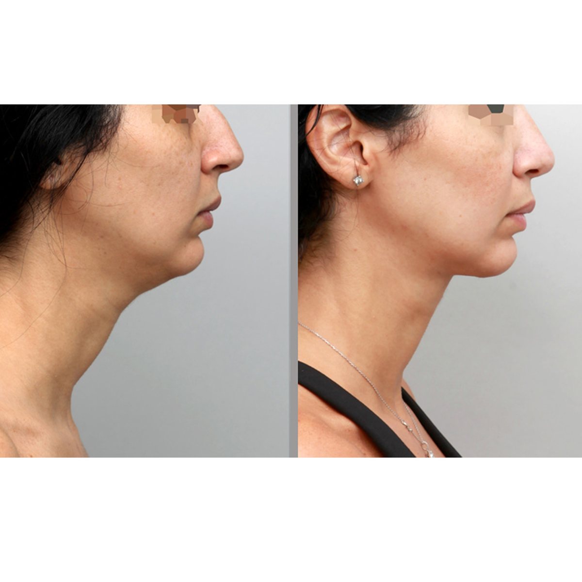Neck liposuction before and after, 35-year-old woman, profile, 1 year after surgery, Ditesheim Cosmetic Surgery Charlotte NC