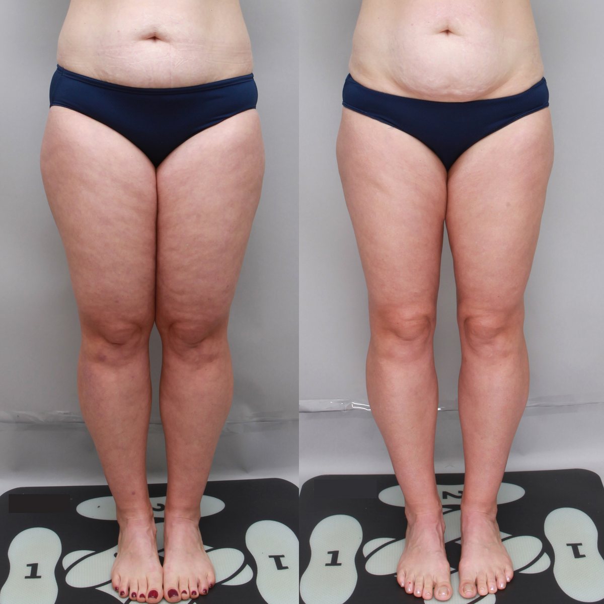 Thigh liposuction before and after, 42-year-old woman, front view, 5 months after surgery, Ditesheim Cosmetic Surgery Charlotte NC