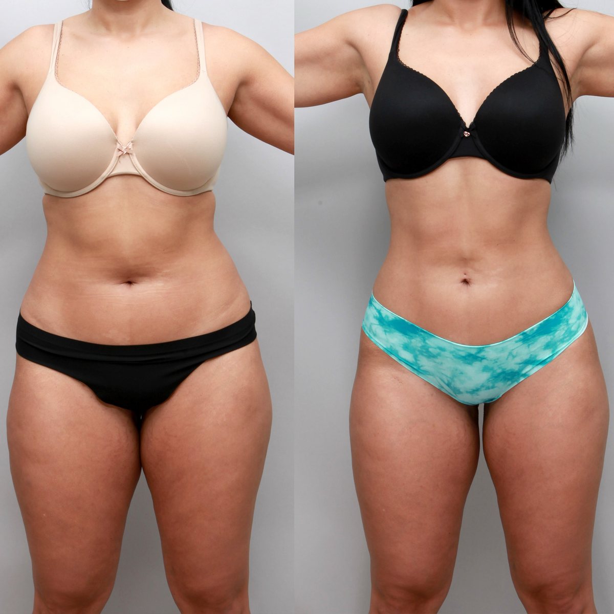 Tummy and waist liposuction before and after, 32-year-old woman, front view, 3 months after surgery, Ditesheim Cosmetic Surgery Charlotte NC