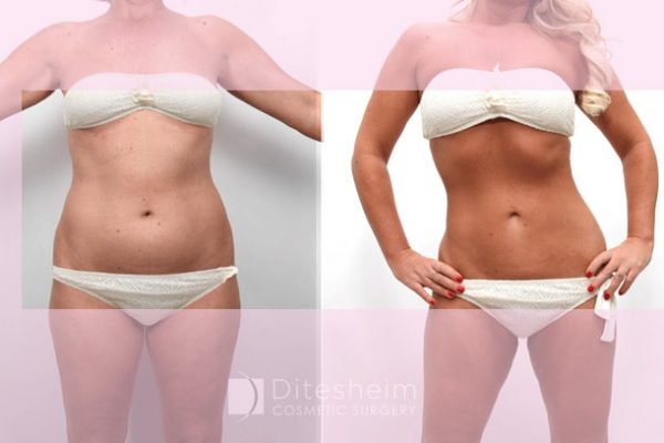 40 woman front view before and after Lipo360 (circumferential liposuction) of torso to define waist, curves and flat tummy