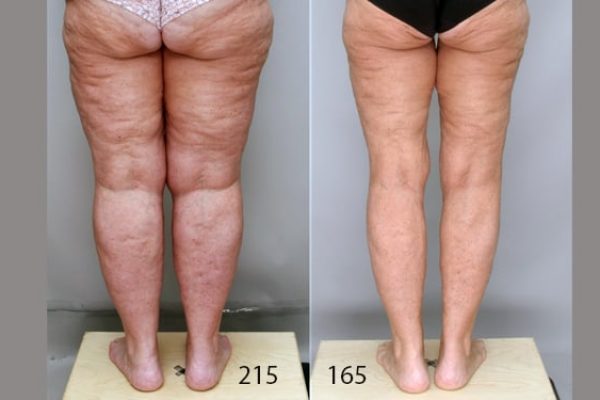 Lipedema Surgery Charlotte NC