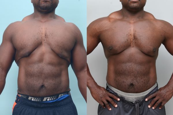 “Before and after male gynecomastia correction showing improved upper body contour and natural masculine appearance | Ditesheim Cosmetic Surgery Charlotte