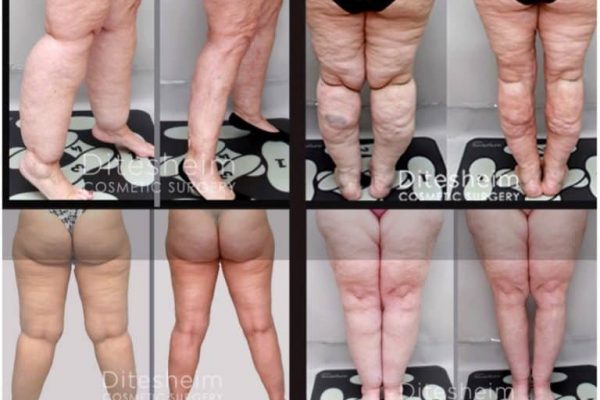a person's legs before and after a lipedema procedure