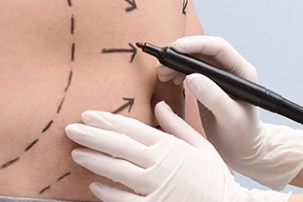 Doctor’s hands marking with arrows and dotted lines, the abdomen of a man prior to surgery