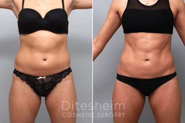 Woman's body before and after Liposuction in Abdomen with Hi definition technique, front view