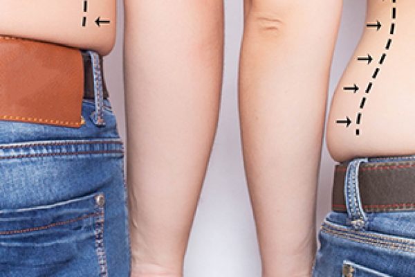 back central part of the body of a man and a woman, marked for surgery with black dots and arrows