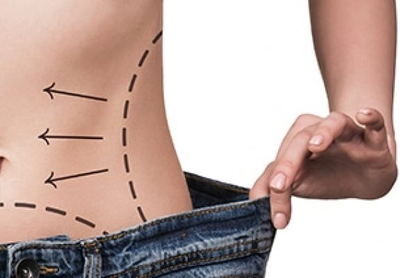 woman showing the waist of a pants that is loose, and her waist marked with dotted lines prior to surgery