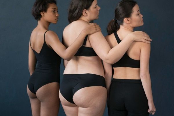 Women standing together before undergoing specialized lipedema reduction surgery treatment