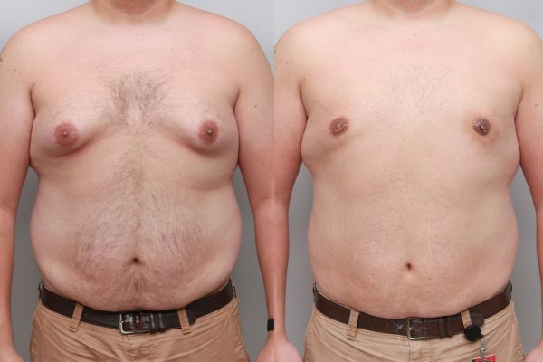 “Before and after male gynecomastia correction showing improved upper body contour and natural masculine appearance