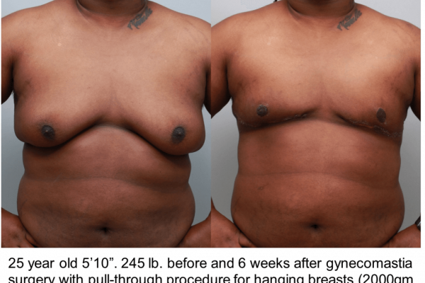 Man's chest before and after gynecomastia with pull through technique, front view