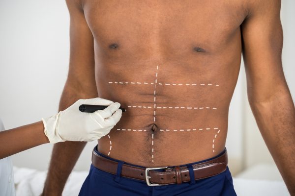 Close-up Of Person's Hand Drawing Correction Lines On Abdomen Of Man